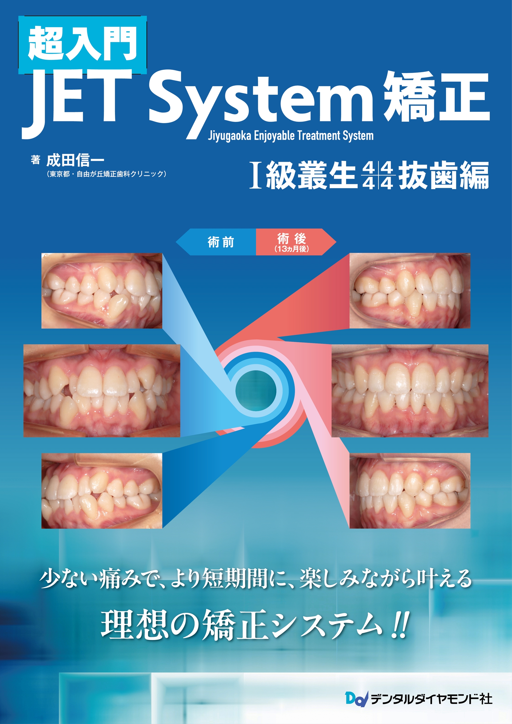 dショッピング |成田信一 「超入門 JET System 矯正 I級叢生4444抜歯編